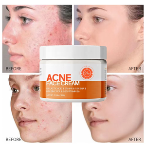 2025 New DY Nhanh Chóng Hiệu Quả Thảo Dược Loại Bỏ Mụn Trứng Cá Kem Chăm Sóc Da Giữ Ẩm Thu Nhỏ Lỗ Chân Lông Kiểm Soát Dầu Mụn Trứng Cá Gel Mặt Kem - Product Image 2