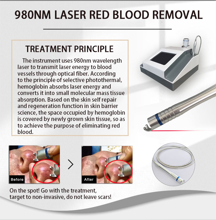 Máquina de remoção vascular do laser do diodo 980 nm, máquina da remoção do varizes do aranha do laser/980nm