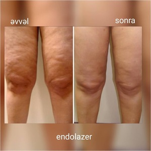 지방 흡입 지방 분해 바디 쉐이핑 슬리밍 장비 980nm1470nm 다이오드 레이저 제거 Papada f 리프트 - Product Image 6