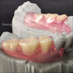 Suministros para dentaduras postizas DIY, dentadura postiza Invisible Valplast, buena nueva técnica protésica, prótesis para dentaduras postizas adelomórficas con buenos precios - Product Image 1