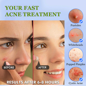 OEM biểu tượng tùy chỉnh Hàn Quốc chống mụn trứng cá da mụn vá mụn trứng cá Hydrocolloid cây trà mụn trứng cá chủ vá - Product Image 4