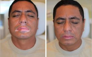 Lampu Laser 308 nm, alat perawatan penyakit Vitiligo dan Psoriasis - Product Image 4