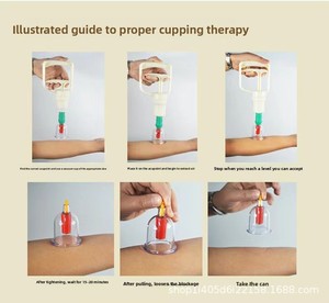 Set Professionale per Terapia con Coppettazione Baibaikang 32 Pezzi, Controllo Manuale, Coppe Hijama in ABS per Rilassamento Muscolare Totale - Product Image 3