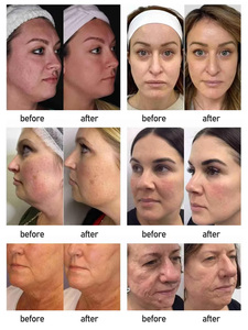 Hign chất lượng xách tay loại bỏ nếp nhăn chống lão hóa Cartridge cơ thể mặt nâng máy sử dụng nhà vẻ đẹp - Product Image 5