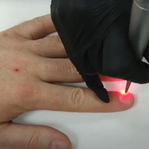 Máquina <span class=keywords><strong>láser</strong></span> de <span class=keywords><strong>hongos</strong></span> en las <span class=keywords><strong>uñas</strong></span> de alta potencia a <span class=keywords><strong>precio</strong></span> de fábrica, <span class=keywords><strong>Láser</strong></span> de <span class=keywords><strong>hongos</strong></span> en las <span class=keywords><strong>uñas</strong></span> utilizado para <span class=keywords><strong>hongos</strong></span> en las <span class=keywords><strong>uñas</strong></span> de los pies - Product Image 5