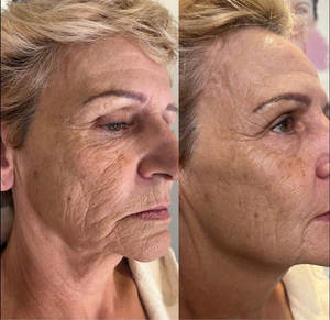 Аппарат для фотодинамической терапии (LED PDT) с 5-цветным светом для лечения розацеа, чувствительности кожи, акне и омоложения кожи - Product Image 4