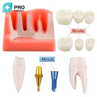Modèle de développement de caries dentaires, modèle de dents dentaires pour l'étude de l'anatomie des dents dentaires, éducation médecin-patient et soins bucco-dentaires