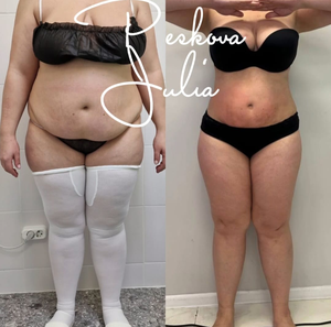 جهاز فيزر لشفط الدهون 980 نانومتر 1470 نانومتر جهاز ليزر ليبوليسيس رفع داخلي - Product Image 4