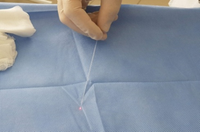 Fiber radiale pour la liposuccion, 400um/600um/800um, 1 unité