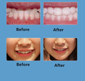 Accesorios de Ortodoncia de Marca Personalizada de 3 Etapas D1 D2 D3 Protectores Bucales Correctores de Dientes Consumibles Dentales <span class=keywords><strong>para</strong></span> Alineación Dental - Product Image 2