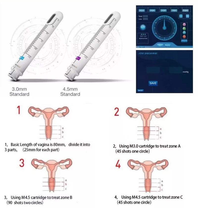 High Effectiveness Intimate Tightening Moisturizing Machine Transducer Vagine Tightening Machine