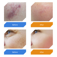 Appareil laser fractionnel CO2 portable, technologie de radiofréquence fractionnée CO2, système de raffermissement vaginal, utilisation à domicile, salon