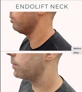 Máquina de Lifting Facial y Lipólisis con Láser de Fibra Endoláser de <span class=keywords><strong>980</strong></span>+1470nm, Liposucción Endoláser - Product Image 5