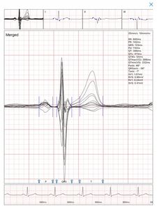 Hot bán 2024 HOMECARE chăm sóc sức khỏe Nguồn cung cấp ECG cho IOS kết nối với Bluetooth CE - Product Image 2