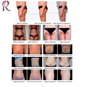 Máquina Comercial de Moldeado en Frío con 5 Manijas, Equipo de Belleza Antiarrugas con Renovación de Colágeno para Spa y Tiendas - Product Image 5