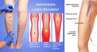 Laser EVLT 1470nm pour l'élimination des varices, Varicosité, EVLA 980NM, Traitement endoveineux efficace, Arfurla, Direct usine