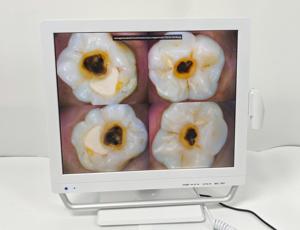 ระบบกล้องเอ็นโดสโคปทางทันตกรรมแบบพกพาอเนกประสงค์พร้อมจอภาพดิจิตอล HD ขนาด 17 นิ้ว สำหรับคลินิกทันตกรรม - Product Image 1