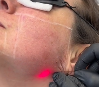 SMA905 fibre laser chirurgicale Fibre Radiale 400um 600um Varices Conique Fibre hémorroïdes 800um Liposuccion lifting