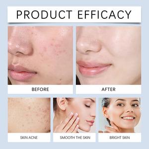 Etiqueta privada Ácido salicílico natural Lavado DE CARA Ingredientes veganos Control de aceite <span class=keywords><strong>Limpiador</strong></span> facial antiacné para grasa seca sensible - Product Image 4