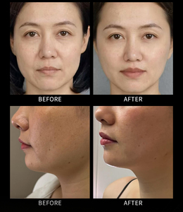 Perfectlaser - Máquina Portátil de Rejuvenecimiento Facial <span class=keywords><strong>HIFU</strong></span> 12D, Precio de Máquina de Belleza <span class=keywords><strong>HIFU</strong></span> Profesional de Ultrasonido Focalizado de Alta Intensidad - Product Image 5