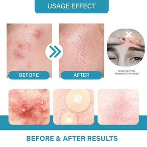 Trong suốt Sao mụn mụn nhọt các bản vá lỗi nhãn hiệu riêng chăm sóc da cho mụn trứng cá da và loại bỏ đốm đen - Product Image 6