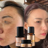 Best-seller - Ensemble de soin pour éliminer les taches noires et les taches brunes - Correcteur de teint - Traitement du mélasma - Gommage chimique pour le visage - Kits professionnels 3 en 1