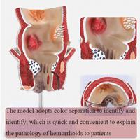 KyrenMed Modèle d'hémorroïde interne externe rectale humaine Modèle pathologique anorectal Modèle de lésion de fissure du rectum Taille réelle