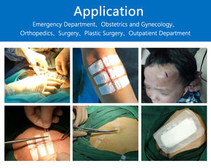 Tiras Médicas Redutoras de Cicatrizes Konlida, Dispositivo de Fechamento de Feridas Adesivo, Tiras de Fechamento de Pele Sem Sutura, Certificado ISO13485 - Product Image 2