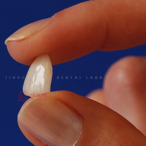 Restauro di protesi dentarie digitali porcellane in ceramica impiallacciatura di vetro più sottile impiallacciatura fissa - Product Image 6