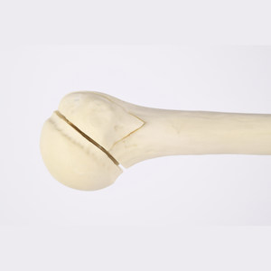 Kyrenmed cortical humerus ขวา fractureed กับ proximal humerus fracture สำหรับการประชุมเชิงปฏิบัติการการตัดเจาะ - Product Image 4