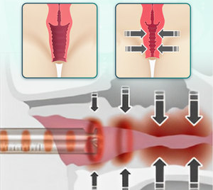 Di alta qualità 980nm 1470nm macchina di serraggio vaginale portatile luce rossa dispositivo di terapia per uso domestico CE approvazione UK/EU Plug - Product Image 5