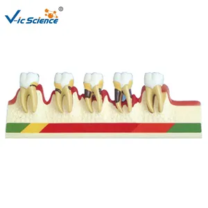牙周疾病发展的牙齿牙齿模型