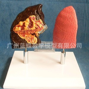 Modelo de pulmón, molde de la estructura pulmonar, riesgos para la salud por el tabaquismo, sistema respiratorio pulmonar del fumador, modelo anatómico patológico del pulmón - Product Image 3