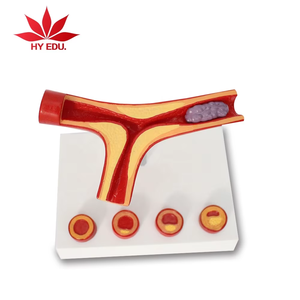 Anatomie humaine Artère et vaisseaux sanguins athérosclérose Modèle de <span class=keywords><strong>pathologie</strong></span> thrombus médical - Product Image 1