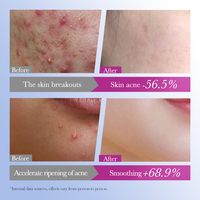 OEM SADOER personnalisé coréen patch de guérison des boutons d'acné maquillage végétalien autocollant de dissolvant de taches de peau d'acné patchs d'acné pour les soins de la peau du visage