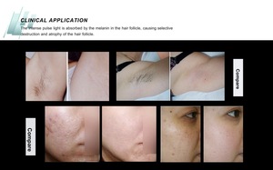 Máquina <span class=keywords><strong>de</strong></span> Depilación Facial DPL Profesional, Depilación Permanente y Rejuvenecimiento Facial con <span class=keywords><strong>Luz</strong></span>, para Uso Doméstico - Product Image 2