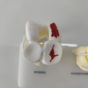 Kyrenmed รูปแบบการรักษาโรคข้อเข่าเสื่อม, แบบจำลองการรักษาโรคข้อเข่าเสื่อม5ขั้นตอน - Product Image 3