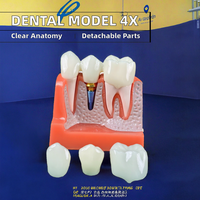 Modèle d'implant dentaire 4 fois Dents en porcelaine Pont couronne amovible Facettes dentaires pour l'enseignement des sciences médicales