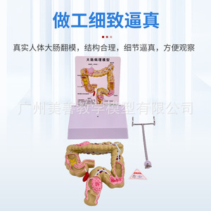 Modelo patológico de intestino grueso, modelo de intestino grueso, modelo gastrointestinal, modelo de enfermedades del colon humano, anatomía de lesiones - Product Image 2
