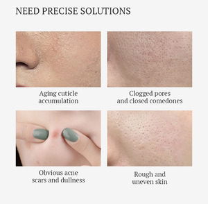 Sérum anti-acné AHA BHA PHA, adoucit les cuticules et atténue les cicatrices d'acné - Product Image 3