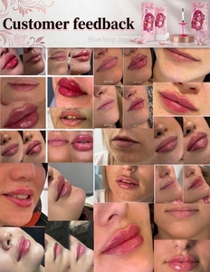 Gel d'acide hyaluronique monophasique réticulé injectable à l'aspect naturel, produit de comblement dermique modéré pour les rides faciales modérées - Product Image 6