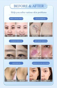 Producto en Tendencia 2026, Máquina de Eliminación de Pigmentos con Láser Picosegundo Q-switch 1064 532nm, Limpieza Facial con Carbón, Blanqueamiento, Eliminación de Tatuajes - Product Image 5