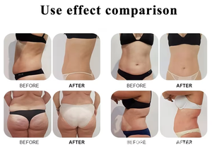 Dispositivo de belleza profesional Venus Legacy para eliminación de grasa, cuatro en uno, para moldear el cuerpo y reafirmar la piel. - Product Image 6