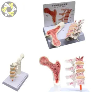 인간의 해부학적인 골다공증 해골 모델 잃을 뼈 해골 모델 인간