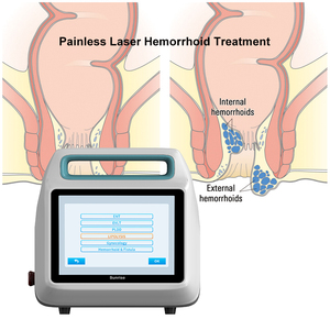 <strong>Hemorrhoid</strong> <strong>Removal</strong> Machine 980nm 1470nm 50W Internal <strong>Hemorrhoids</strong> Piles <strong>External</strong> Anal Fissure - Product Image 1