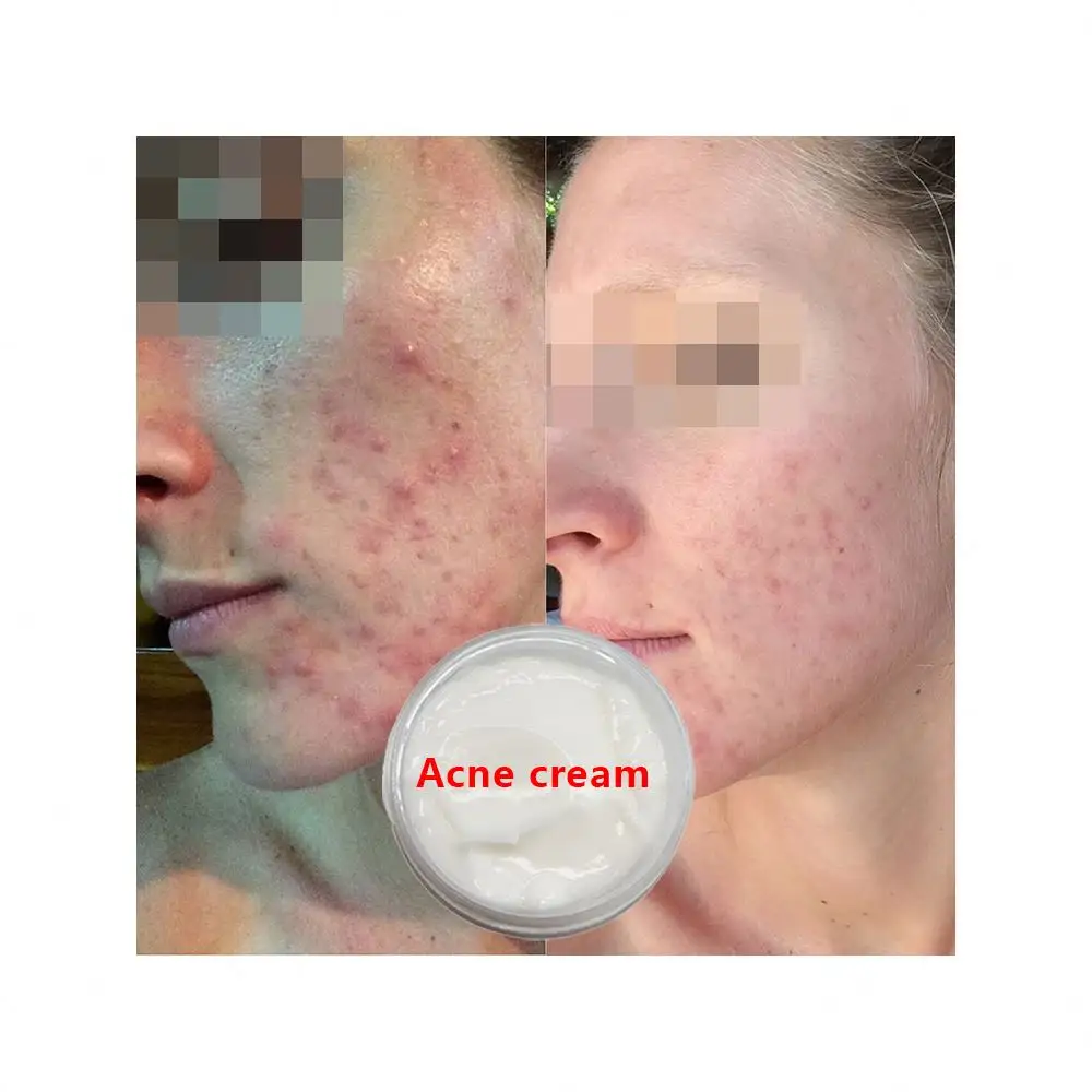 Semi-Finished Cosmetic Products Skin Repair Dark Scar Removal Cream Natural Keloid Acne Scar Removal Face Cream