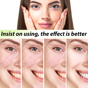 Crema Erboristica Anti-Acne che Attenua le Imperfezioni, Chiude i Punti Neri, Deterge, Idrata e Leviga <span class=keywords><strong>il</strong></span> Viso 30g - Product Image 3