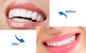 Alineadores Dentales Ortodónticos en Forma de Y, Nuevos, para Brackets Invisibles - Product Image 4