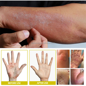 Crema Cinese alle Erbe per il Prurito-Sollievo Naturale per <span class=keywords><strong>Problemi</strong></span> della Pelle - Product Image 5