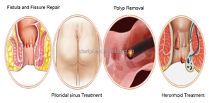 เลเซอร์โพรโทโลยี 980 1470 นาโนเมตร แบบเส้นใยเรเดียลทรงกรวย สำหรับรักษาโรคริดสีดวงทวาร ริดสีดวงทวารรั่ว ริดสีดวงทวารแบบรั่วซึม ด้วยเลเซอร์ไดโอด สำหรับแพทย์ผู้เชี่ยวชาญด้านโพรโทโลยี - Product Image 4